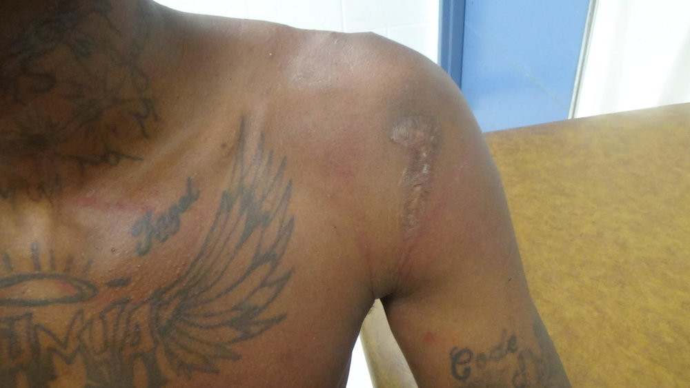 Inmate shows off the scar from a serious injury he received at the MTC-run East Mississippi Correctional Facility in Meridian in 2016. The photo was used as evidence against MTC in the 2018 trial in U.S. District Court in Jackson.   Southern Poverty Law Center