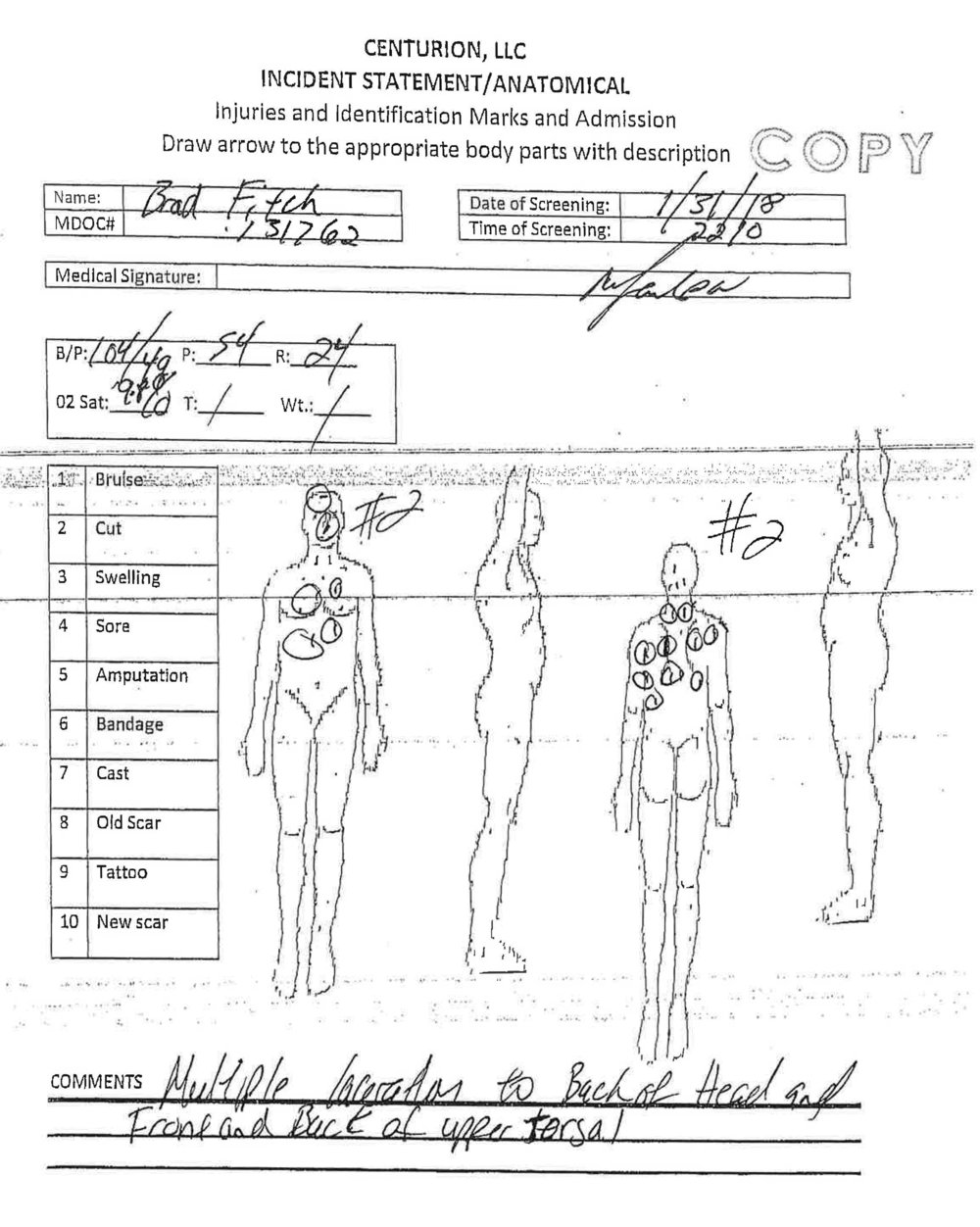 An anatomical diagram from the Mississippi Department of Correction's investigative report into Brad Fitch's death showed multiple lacerations to the back of the head and torso.   Mississippi Department of Corrections